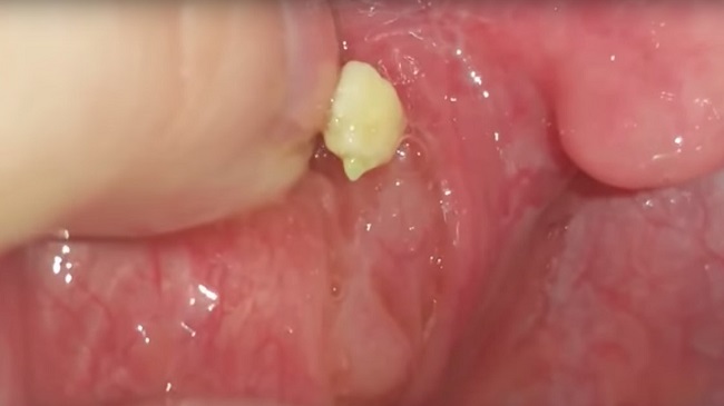 How to Make Tonsil Stones Fall Out